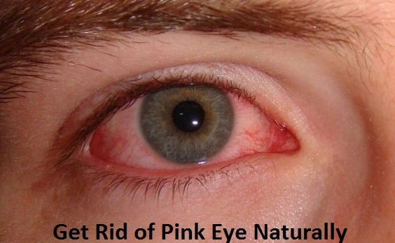 Get Rid of Pink Eye Naturally