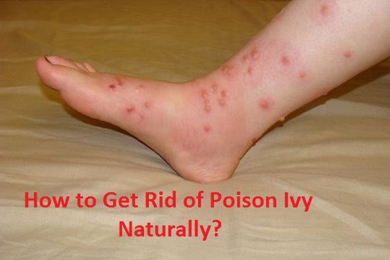 Get Rid of Poison Ivy Naturally
