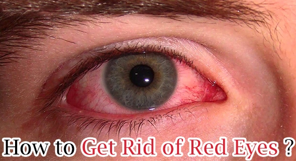 Get Rid of Red Eyes