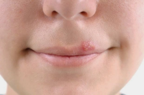 Get Rid of a Cold Sore