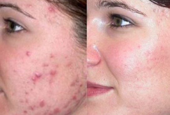 Get-rid-of-acne-scars