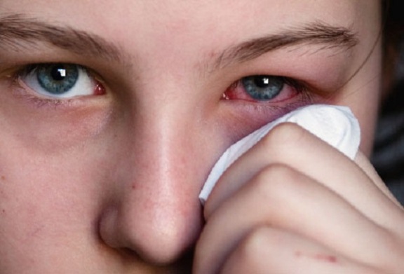 Home remedies for pink eye