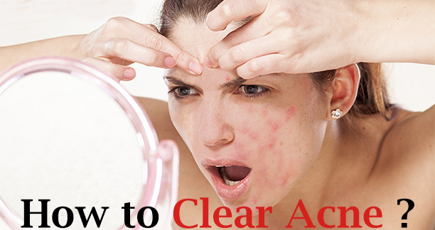 How to Clear Acne