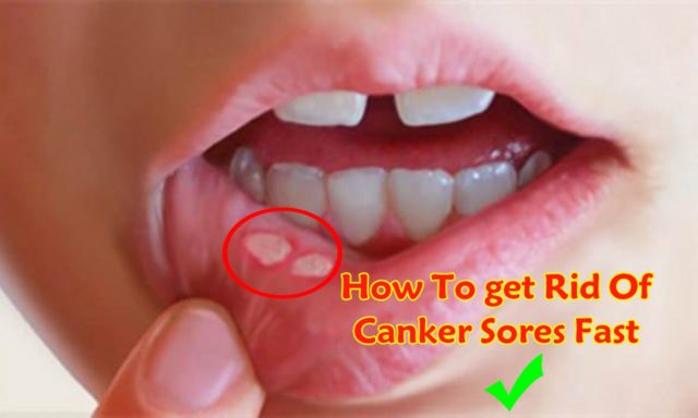 How to Get Rid of a Canker Sore Fast