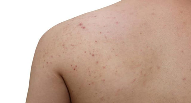 get rid of back acne