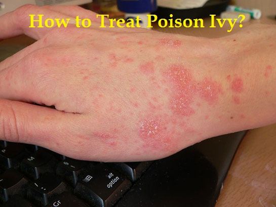 How to treat poison ivy