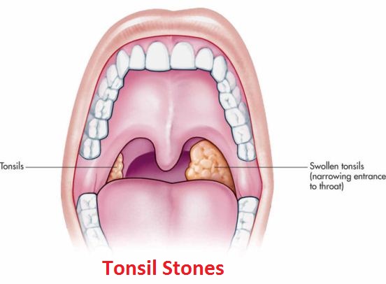 Tonsil Stones