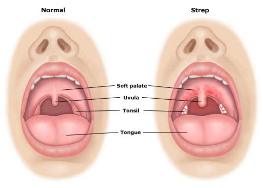 home remedies for strep throat