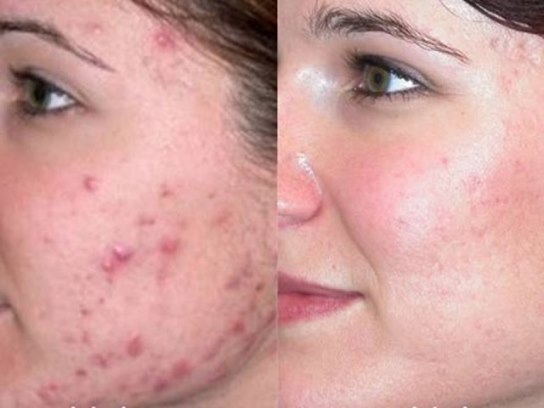 Get rid of acne