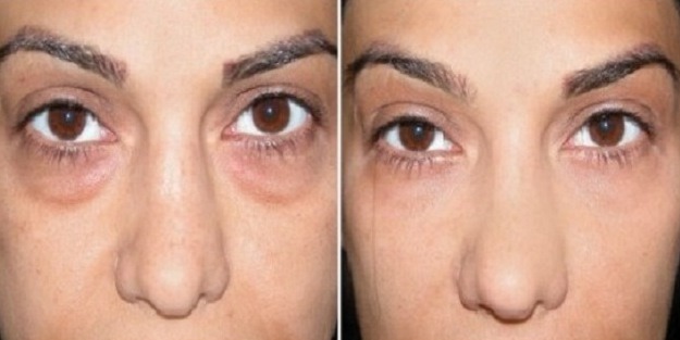 Get Rid of Bags Under Your Eyes