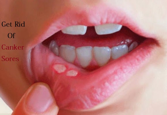 Get Rid of Canker Sores