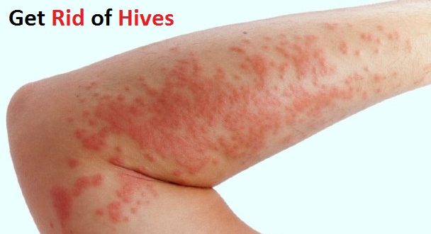 How to Get Rid of Hives?