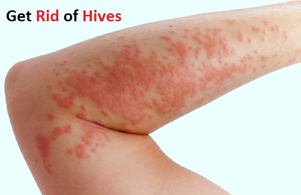 Get rid of hives