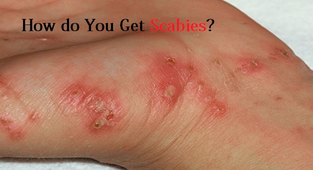 How do You Get Scabies