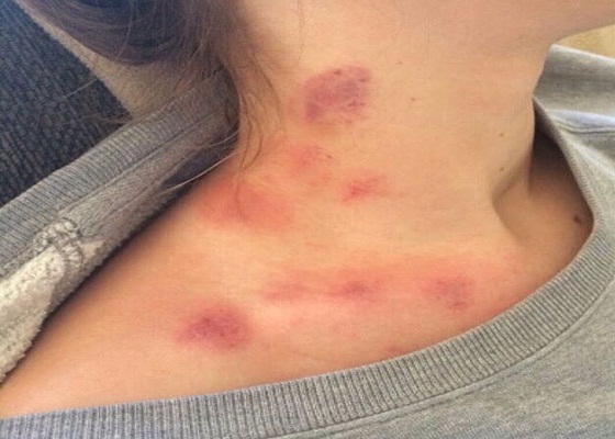 How to Get Rid of Hickeys