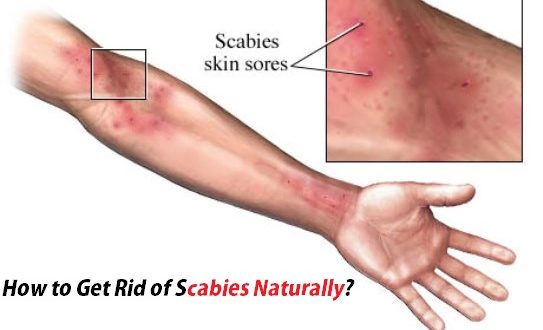 How to Get Rid of Scabies Naturally?