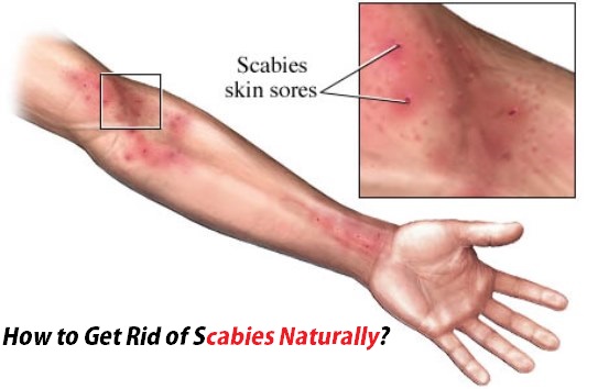 How to Get Rid of Scabies Naturally