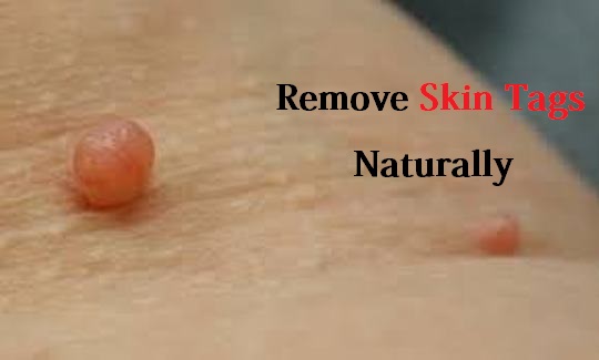 Remove Skin Tags