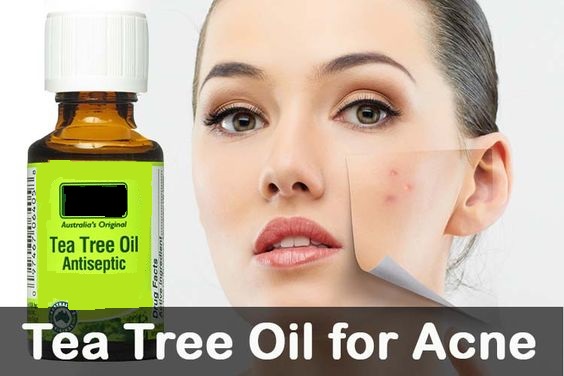 Tea tree oil for acne