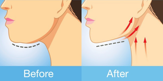 How to get rid of neck fat