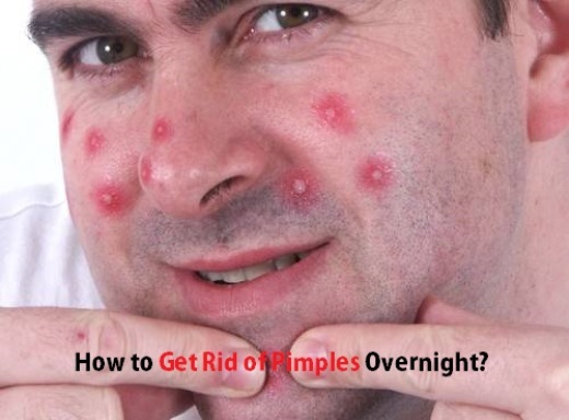 Get Rid of Pimples overnight