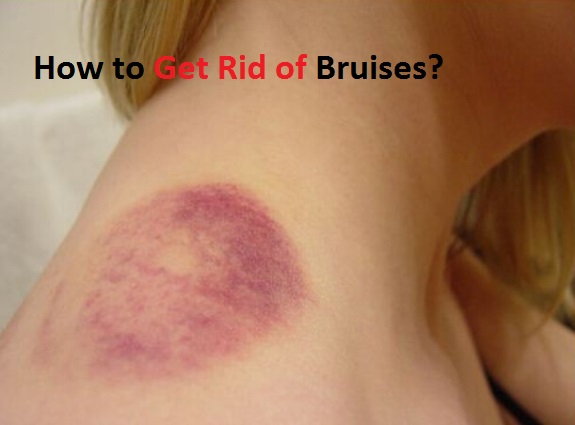how to get rid of bruises