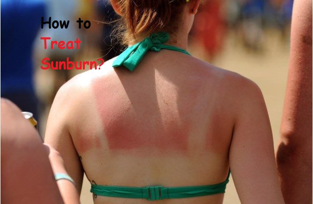 how to treat sunburn?