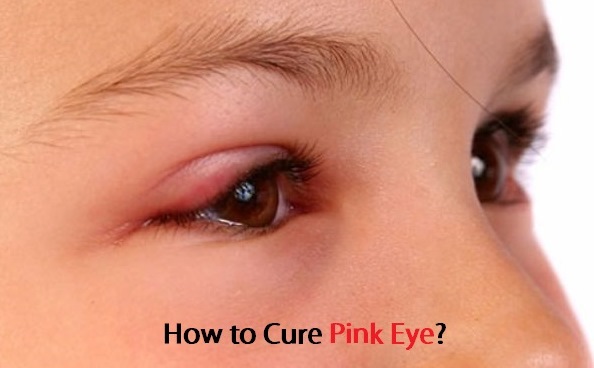 How to Cure Pink Eye?