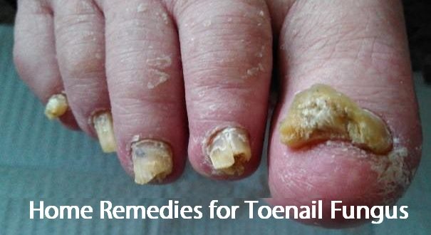 home remedies for toenail fungus