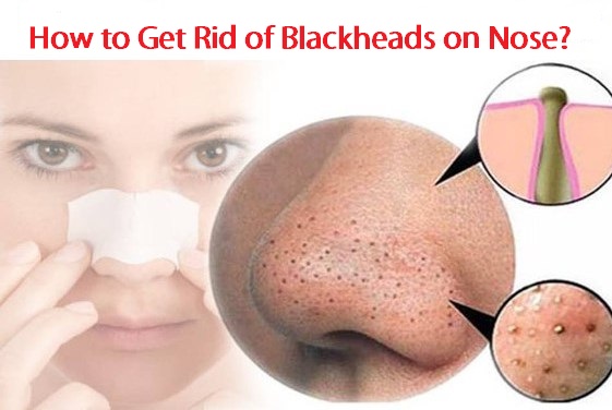 How to Get Rid of Blackheads on Nose?