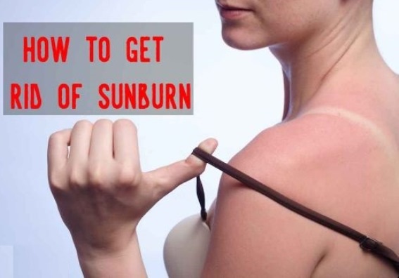 How to get rid of sunburn