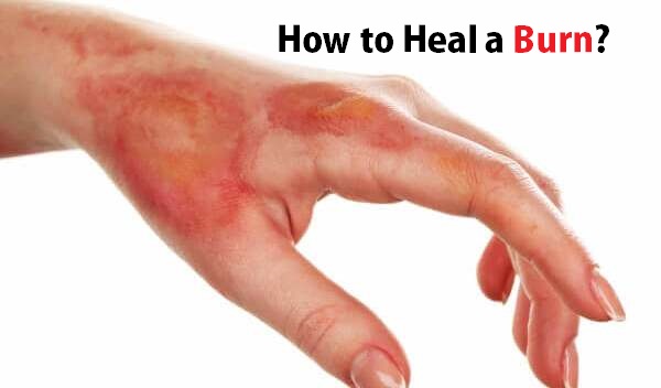 How to Heal a Burn?