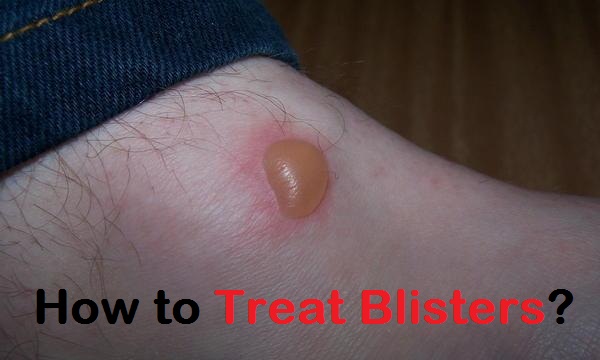 how to treat blisters