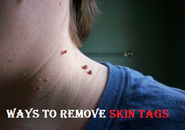 Remove a skin tag