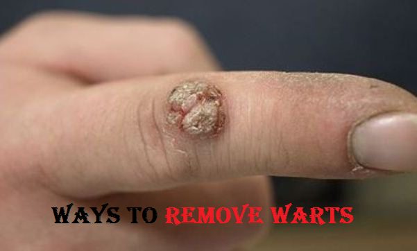 remove warts