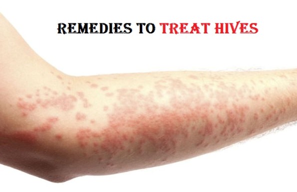 How To Treat Hives