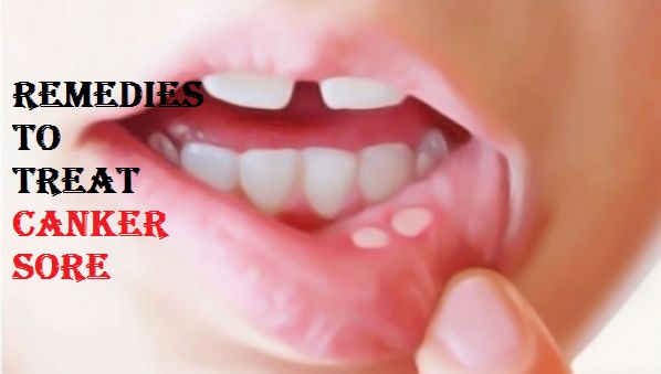 get rid of canker sore