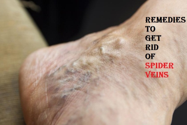 get rid of spider veins