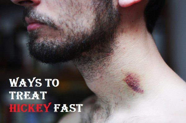 Get rid of a hickey fast