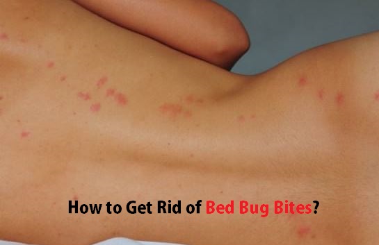 Get Rid of Bed Bug Bites?