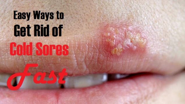 how to get rid of cold sores fast
