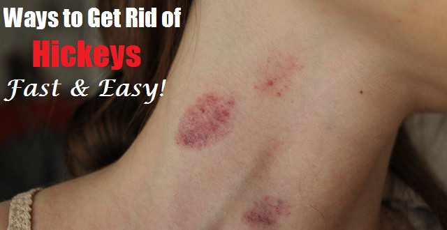 how to get rid of hickeys fast