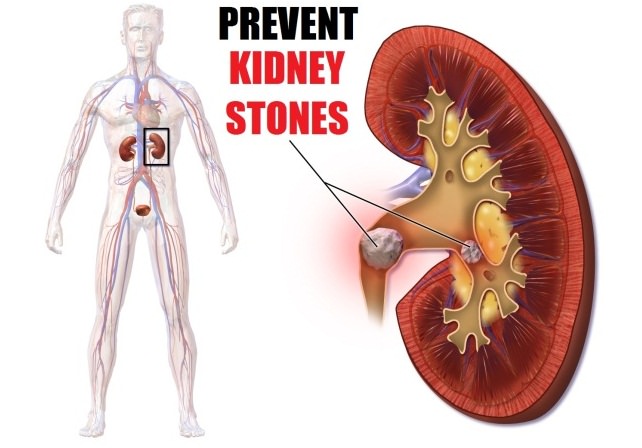 how to prevent kidney stones