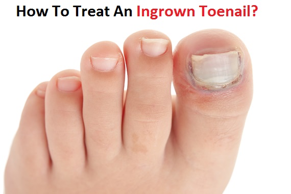 how to treat an ingrown toenail