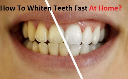 How to Whiten Teeth Fast at Home?