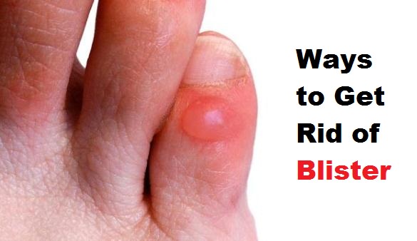 get rid of a blister