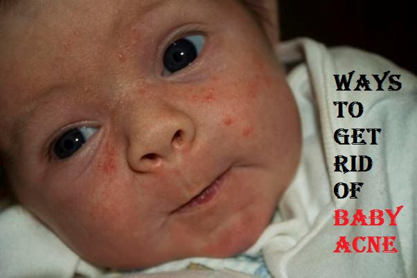 get rid of baby acne